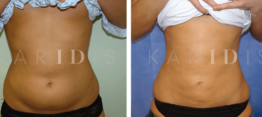 Abdomen reshaping with liposuction results