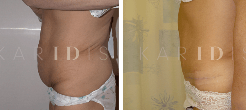Abdominoplasty Before and Afters