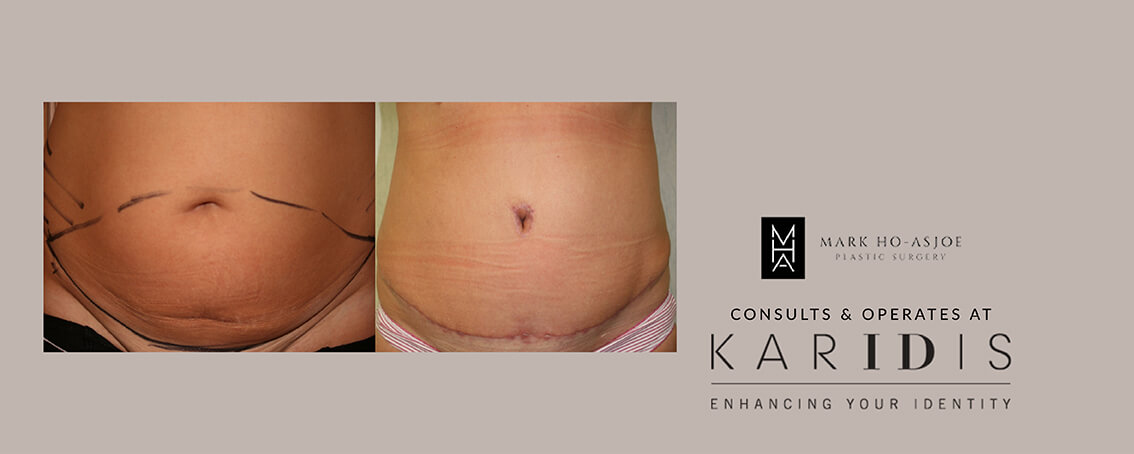 Abdominoplasty by Mr Mark Ho-Asjoe at Karidis Clinic