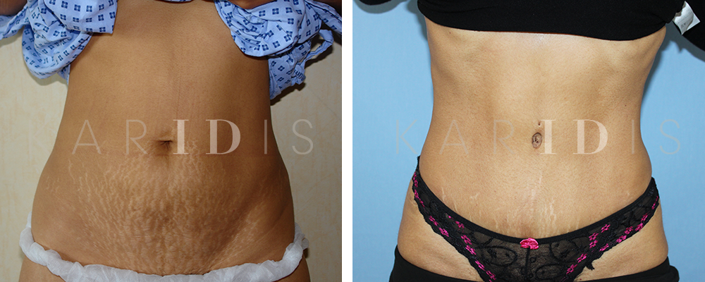 Tummy Tuck Before & After Pictures