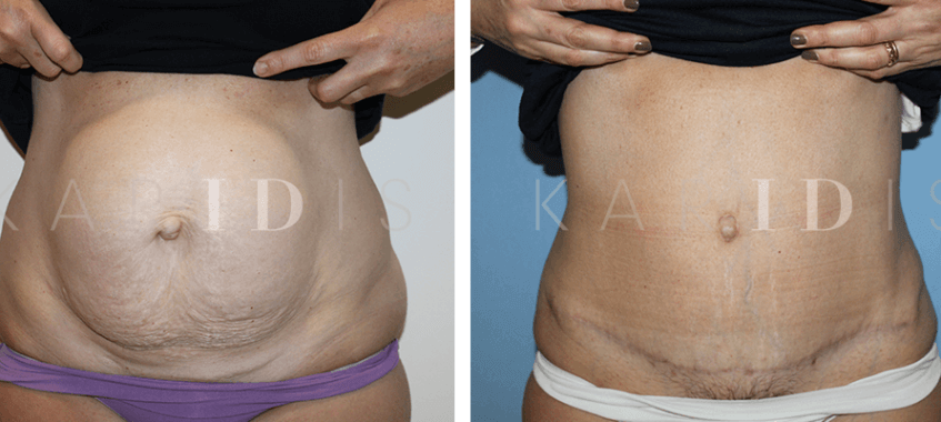 Abdominoplasty with lipo and abdominal muscle repair