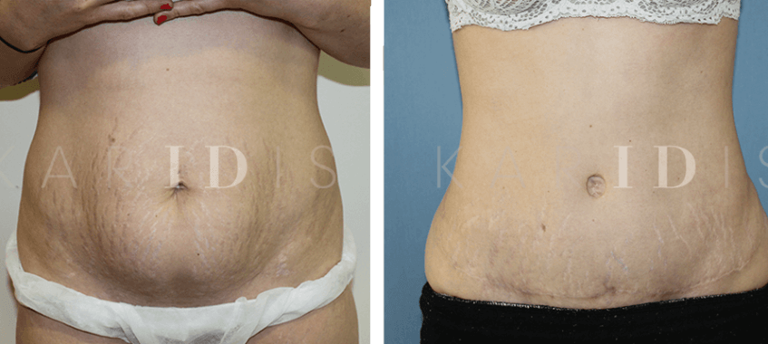 Abdominoplasty with lipo to waist results