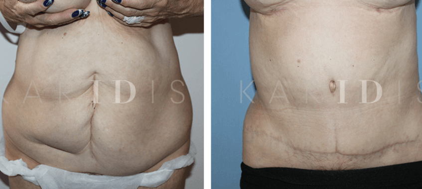 Abdominoplasty with liposuction before and afters