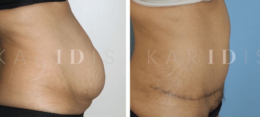 Abdominplasty and muscle repair results