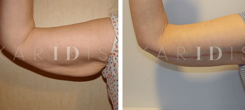 Arm Lift Surgery Results
