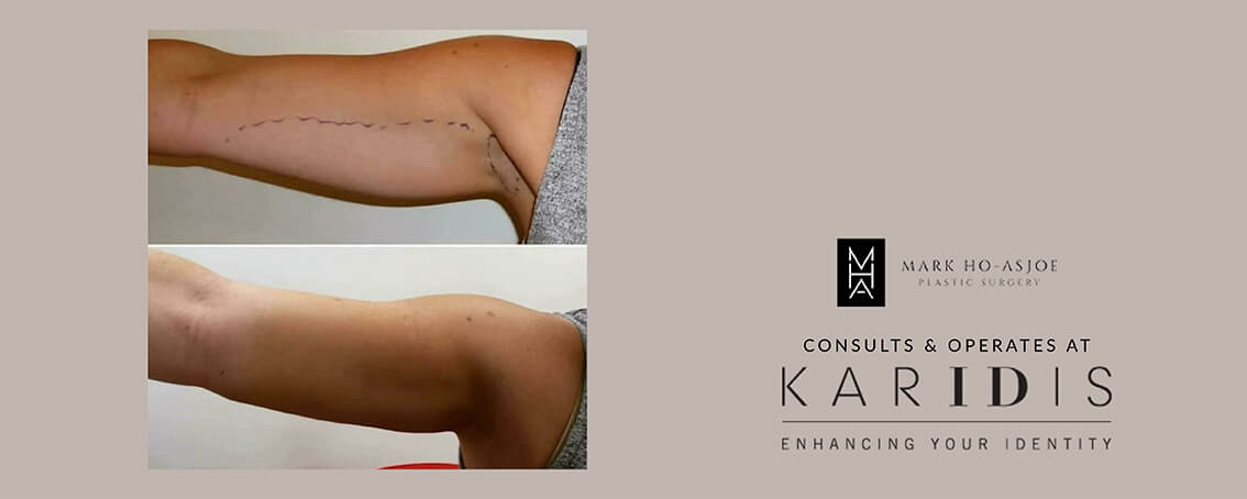 Arm Reduction Surgery by Mr Mark Ho-Asjoe at Karidis Clinic