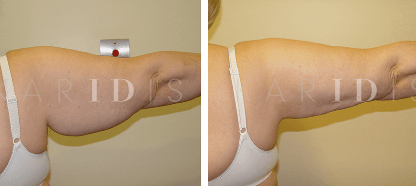 Arm liposuction before and afters
