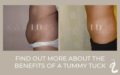 Benefits of a tummy tuck