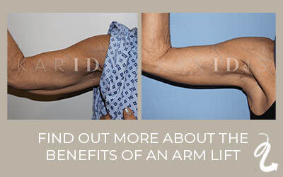 Benefits of an arm lift