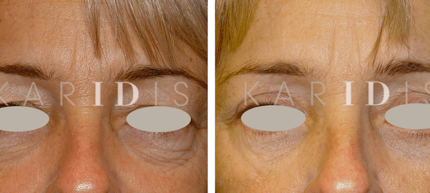 Blepharoplasty Before and Afters