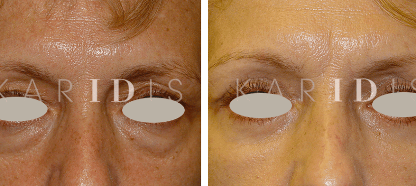 Blepharoplasty Before and Afters 12