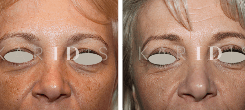 Blepharoplasty Before and Afters