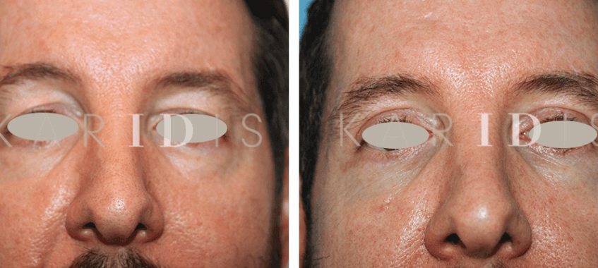 Blepharoplasty Before and Afters