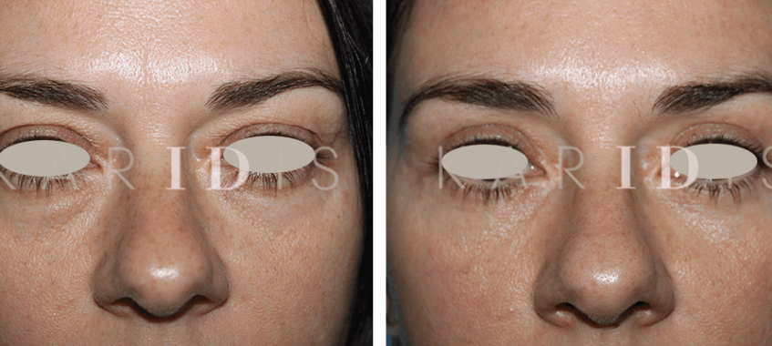 Blepharoplasty Before and Afters