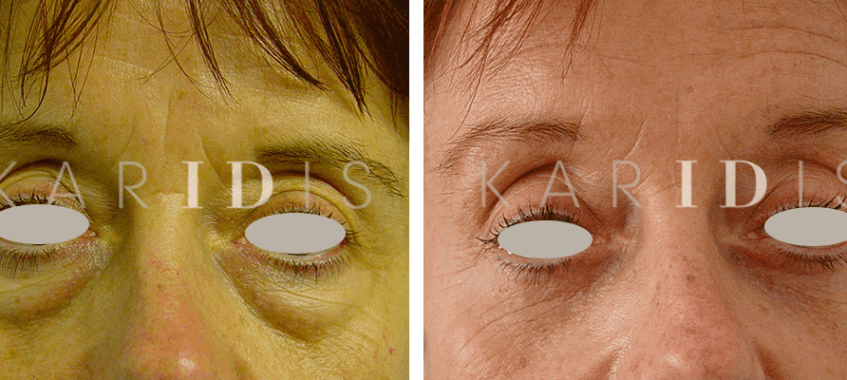 Blepharoplasty Before and Afters