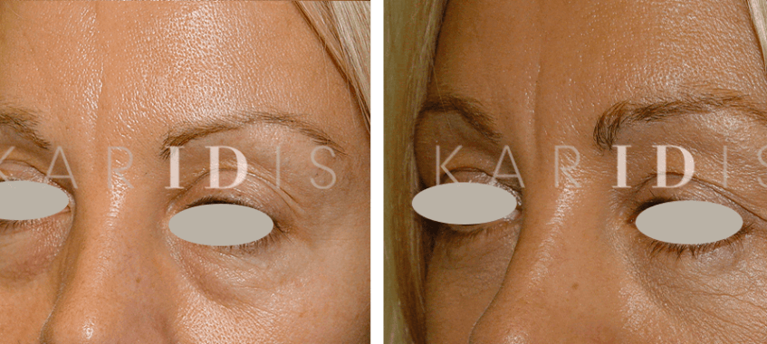 Blepharoplasty Before and Afters