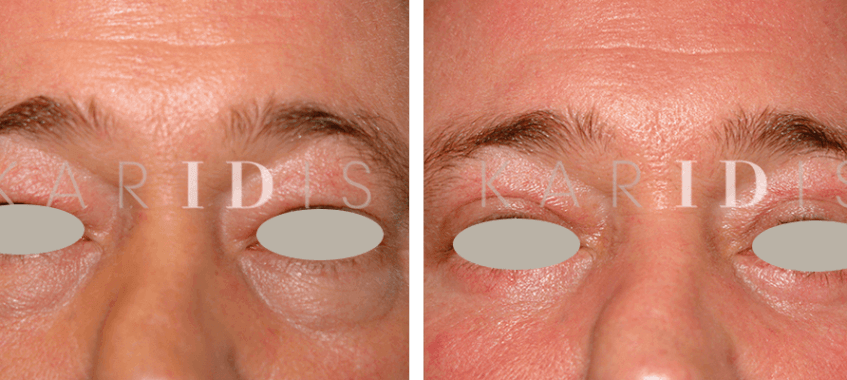 Blepharoplasty Before and Afters 3