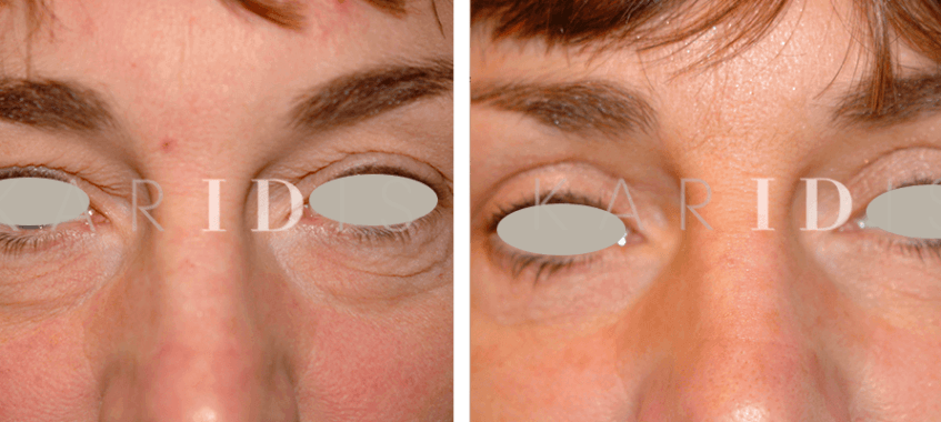 Blepharoplasty Before and Afters