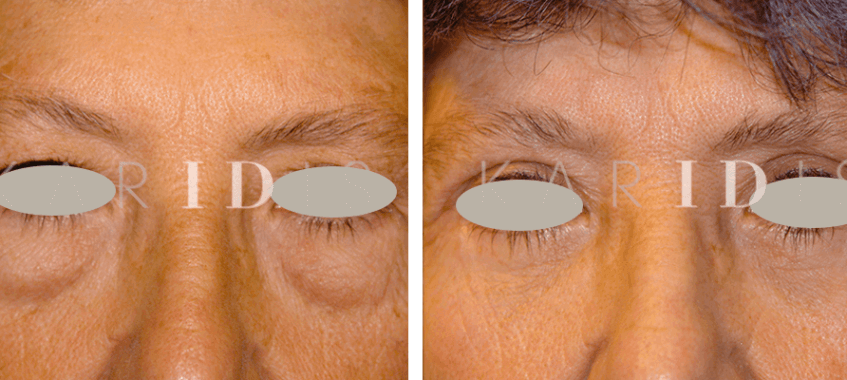 Blepharoplasty Before and Afters