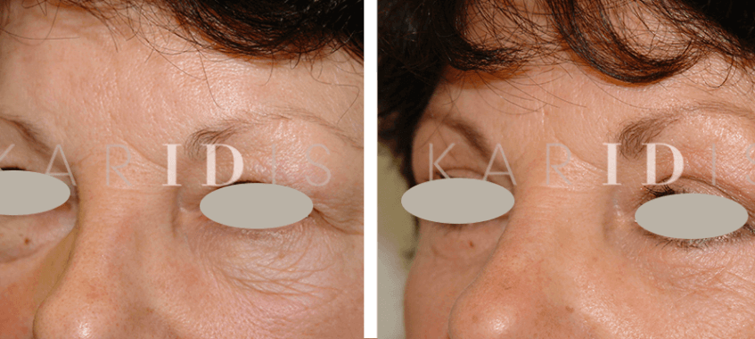 Blepharoplasty Before and Afters