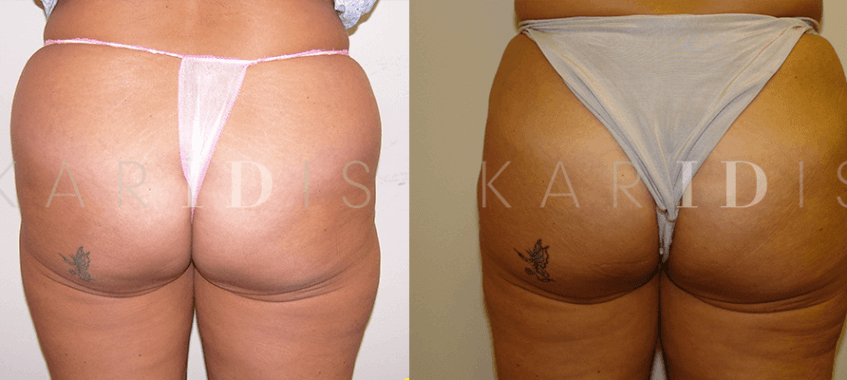 Body reshaping liposuction results