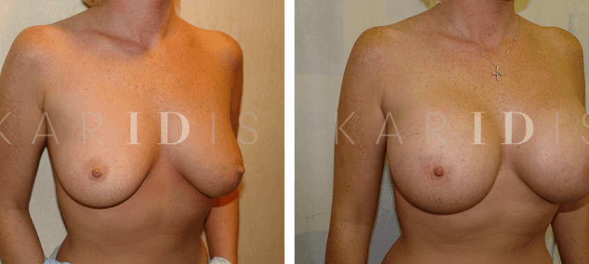 Boob job before and after images