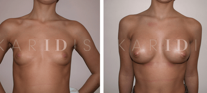 Boob job before and afters