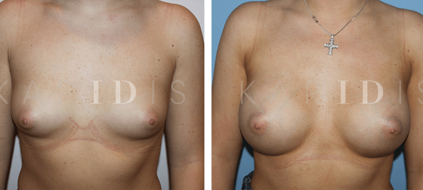 Breast Augmentation Before and Afters