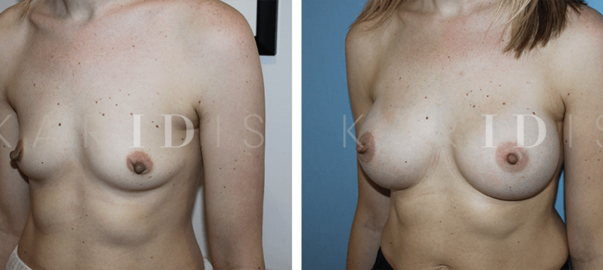 Breast Augmentation before and afters