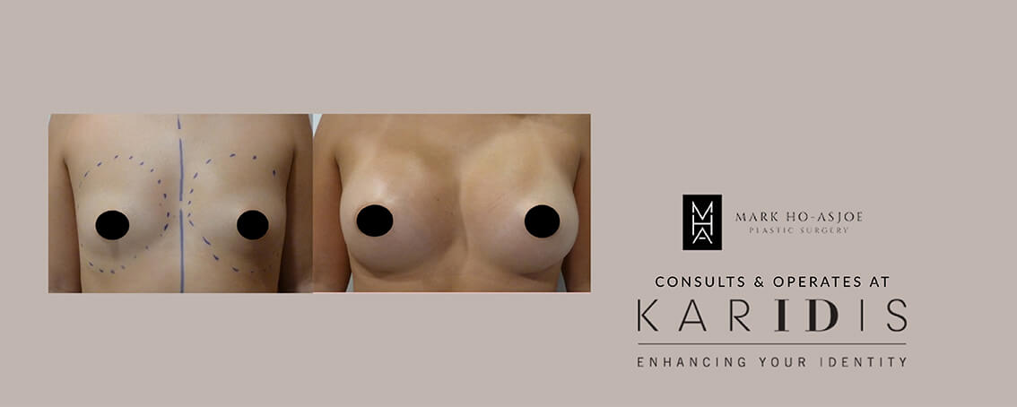 Breast Augmentation with Implants by Mr Mark Ho-Asjoe at Karidis Clinic