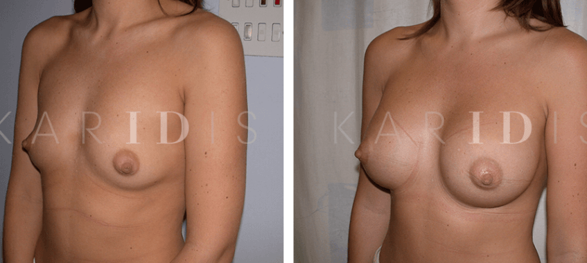 Breast Enhancement results