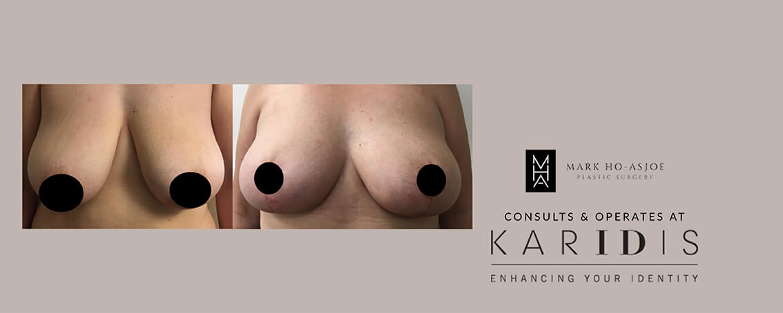 Breast Reduction Surgery by Mr Mark Ho-Asjoe at Karidis Clinic