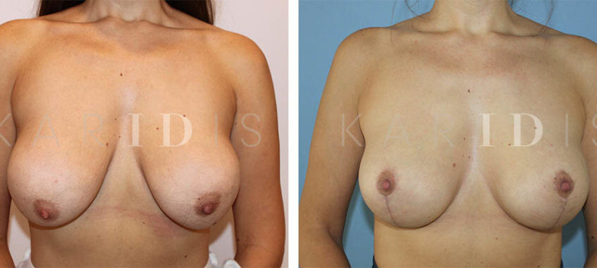 Breast Uplift Before and Afters