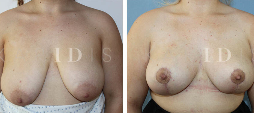 Breast Uplift London