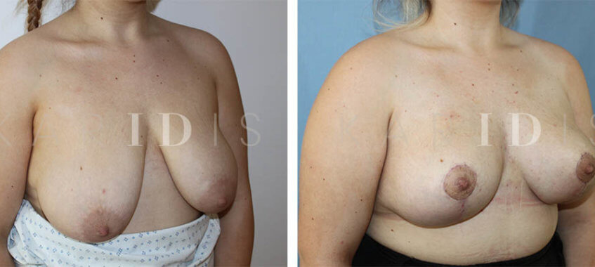 Breast Uplift London Result
