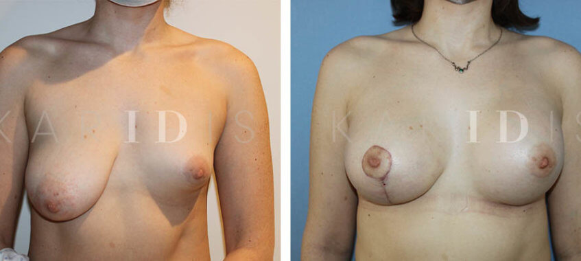 London Breast Uplift