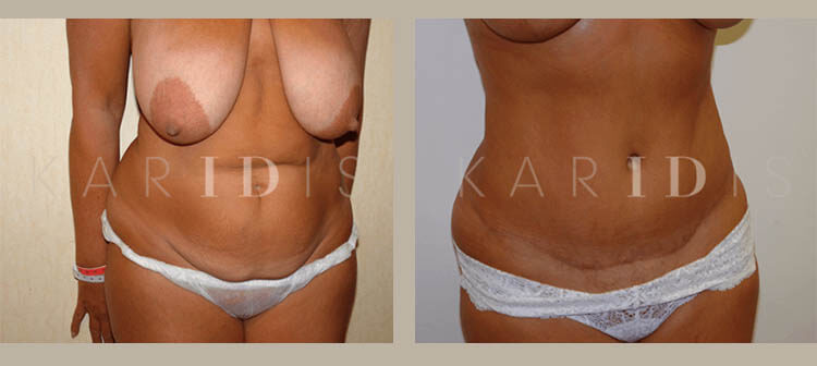 How much is a tummy tuck and breast lift uk Double The Benefits Combination Cosmetic Surgery Karidis Clinic