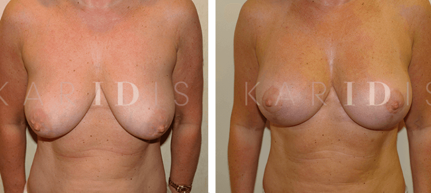 Breast Uplift with implants before and afters