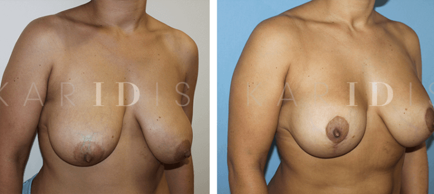 Breast augmenation and breast uplift combined results