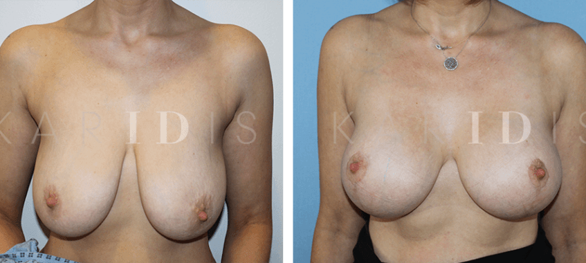 Breast augmentation and breast uplift results
