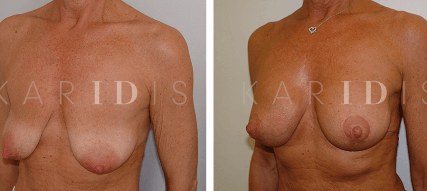 Breast augmentation and implants before and afters