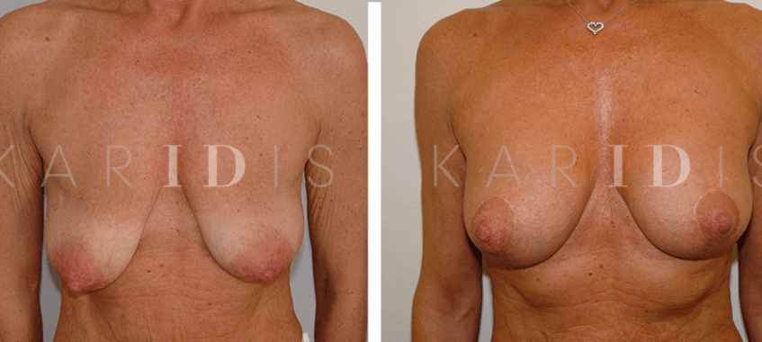 Breast augmentation and implants results