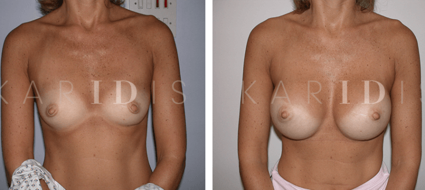 Breast augmentation before and afters