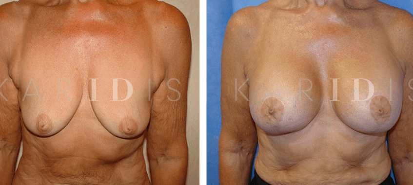 Breast augmentation mastopexy results