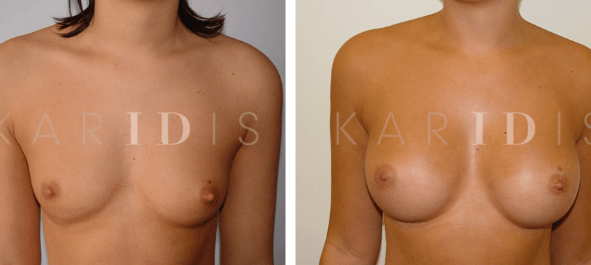 Breast augmentation results