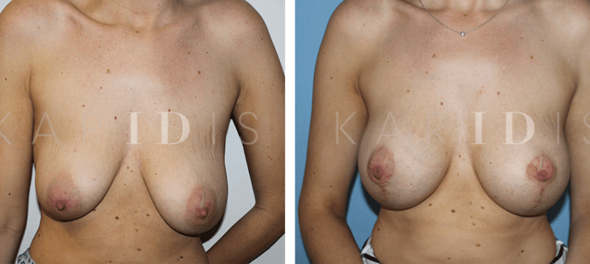 Breast augmentation uplift results