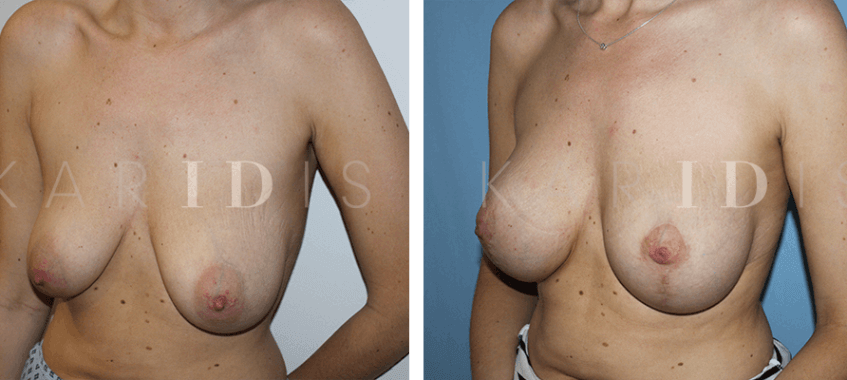 Breast augmentation uplift surgery results