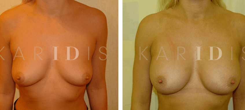 Breast augmentation with breast implants before and afters