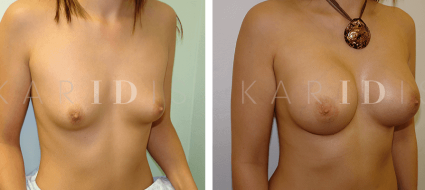 Breast augmentation with implants results