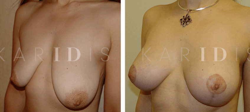 Breast augmentation with uplift before and afters